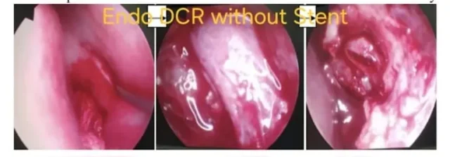 Endoscopic DCR (tear-duct surgery) without stent