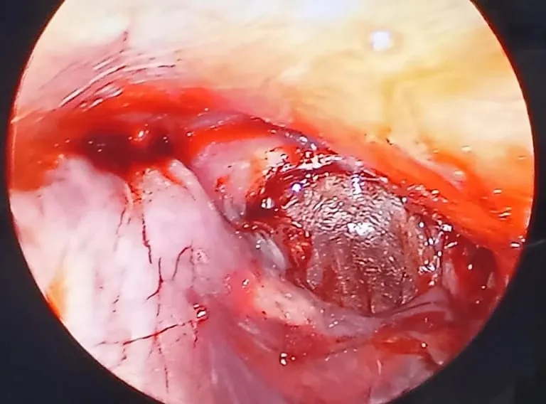 Endoscopic Myringoplasty
