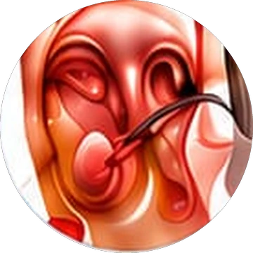 Endoscopic Myringoplasty