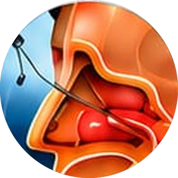 Endoscopic Septoplasty