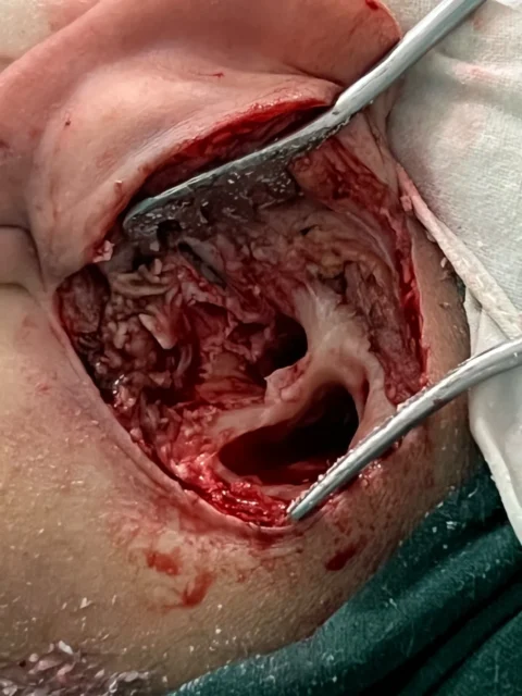 Head & neck surgery — intra-operative view