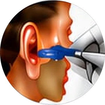 Myringotomy