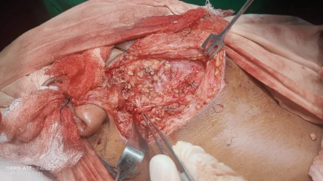 Neck surgery — intra-operative view