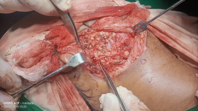 Neck surgery — nerve-preserving dissection