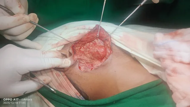 Neck surgery — intra-operative view