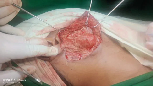Neck surgery — intra-operative view