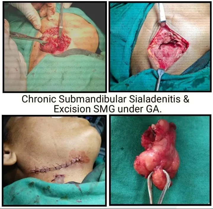 Submandibular Gland Excision
